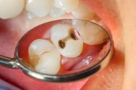 Inilunsad ng Babio ang Advanced Caries Enrichment Medium para sa Maagang Pagtuklas ng Pagkabulok ng Tooth